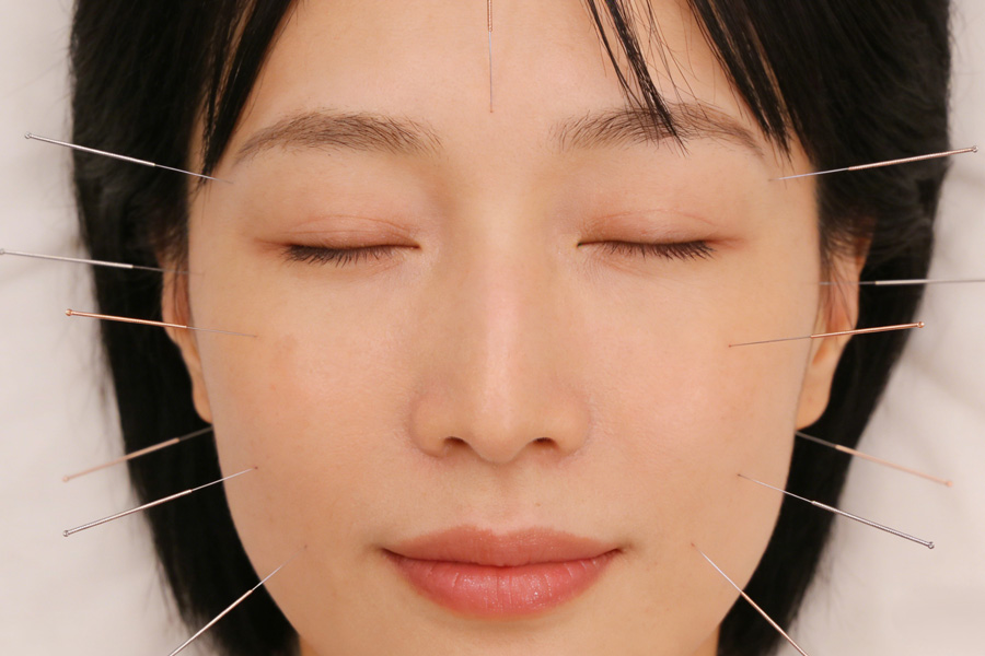 Acupuncture